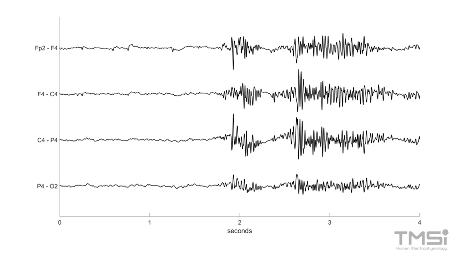 Muscle EEG artifact caused by chewing