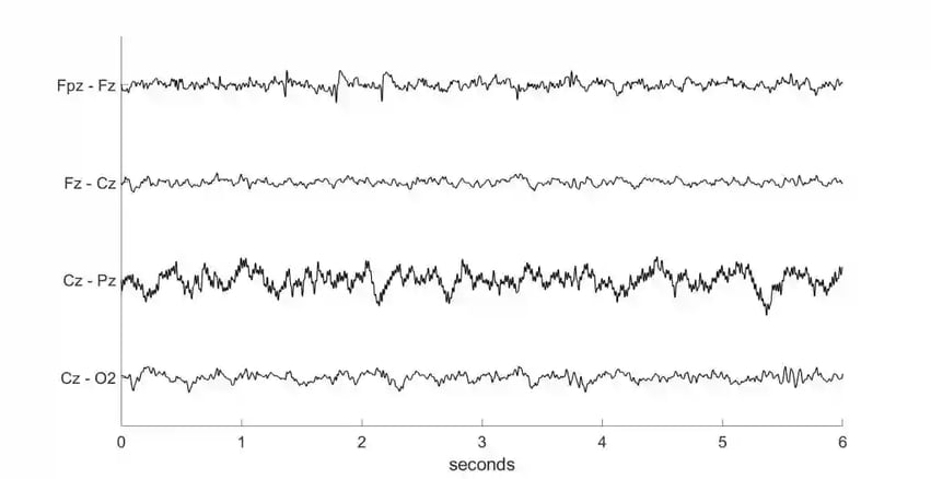Bad channel connection (Pz) on EEG