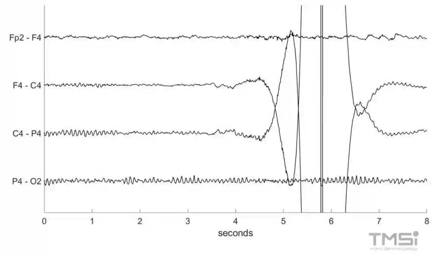 EEG artifacts with electrode pop