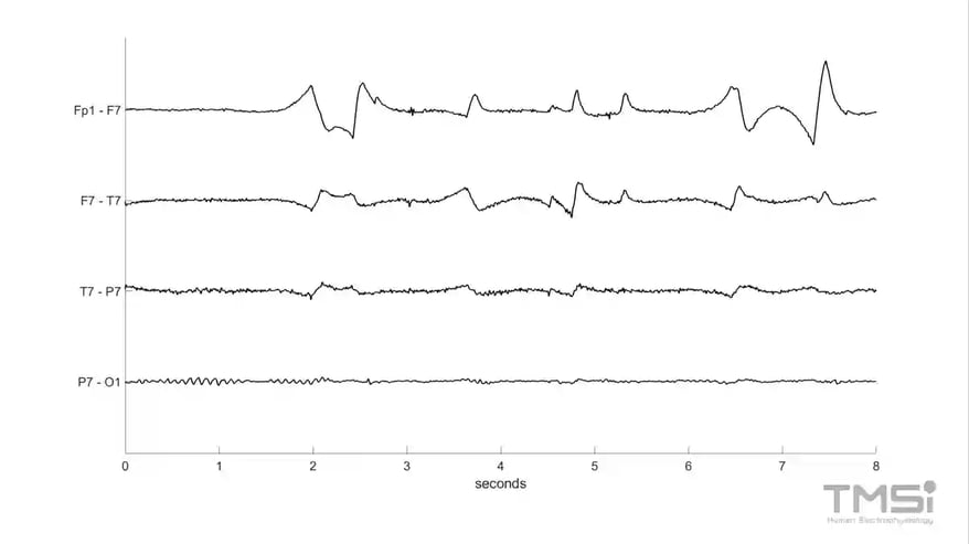 Mains interference on EEG 50Hz 60Hz