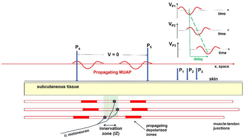 Conduction velocity of MUAP with High-Density EMG